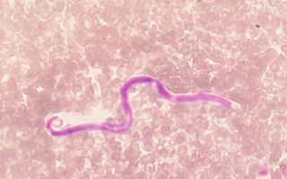 蛲虫图片，蛲虫图片及虫卵图片